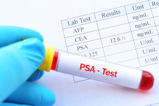 Abnormal high PSA test result with blood sample tube | MyMemories