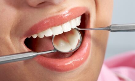 Five Key Benefits of Tooth-colored Fillings