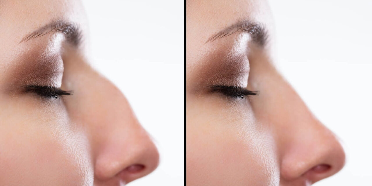 Things to Consider After Nose Surgery