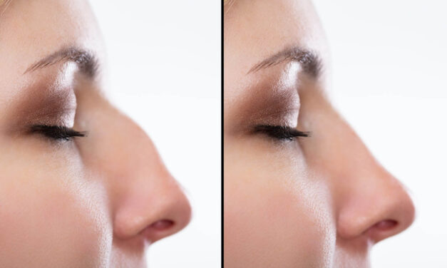 Things to Consider After Nose Surgery